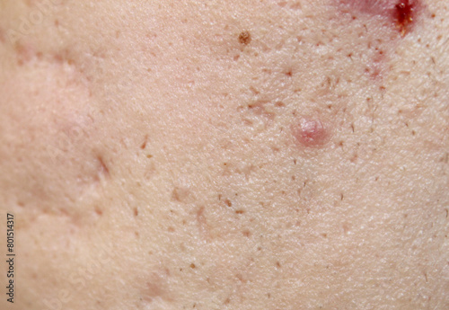 Problem skin with acne marks. Stock human skin texture in the best quality. Photo with scars.