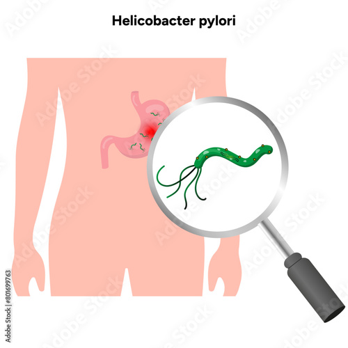 Helicobacter pylori