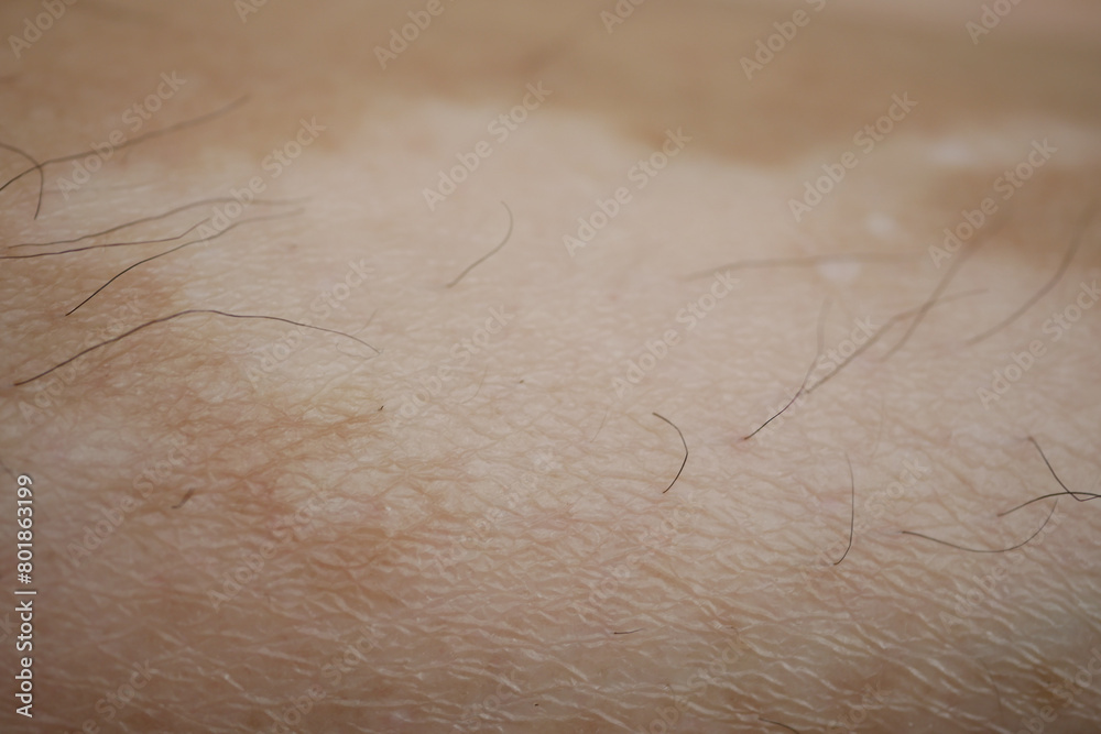 Fototapeta premium feet with vitiligo skin condition.