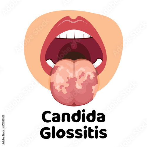 Candida Glossitis vector illustration