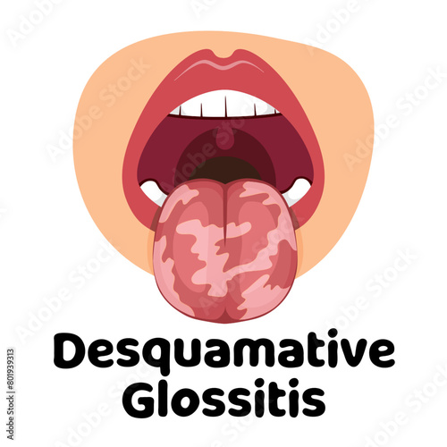 Desquamative Glossitis vector illustration