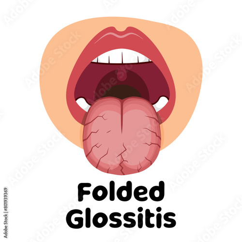 Folded Glossitis vector illustration