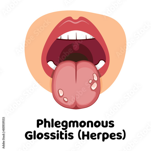 Phlegmonous Glossitis Herpes vector illustration