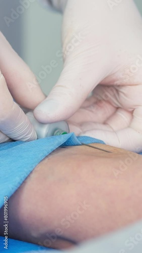 Vertical video. Close-up of blood collection in a clinic or cosmetology center. The concept of health, youth and modern cosmetology technologies. photo