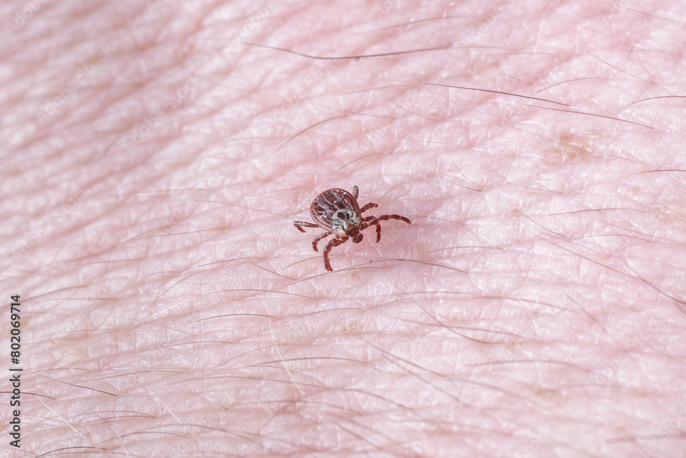 Adult female tick - Ixodes ricinus.A predatory parasitic tick crawls along the human body.Carrier of infectious diseases as encephalitis or Lyme borreliosis. Adult female tick - Ixodes ricinus.A predatory parasitic tick crawls along the human body.Carrier of infectious diseases as encephalitis or Lyme borreliosis.