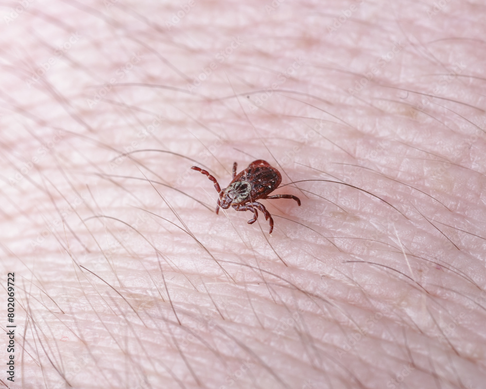 Adult female tick - Ixodes ricinus.A predatory parasitic tick crawls along the human body.Carrier of infectious diseases as encephalitis or Lyme borreliosis. Adult female tick - Ixodes ricinus.A predatory parasitic tick crawls along the human body.Carrier of infectious diseases as encephalitis or Lyme borreliosis.