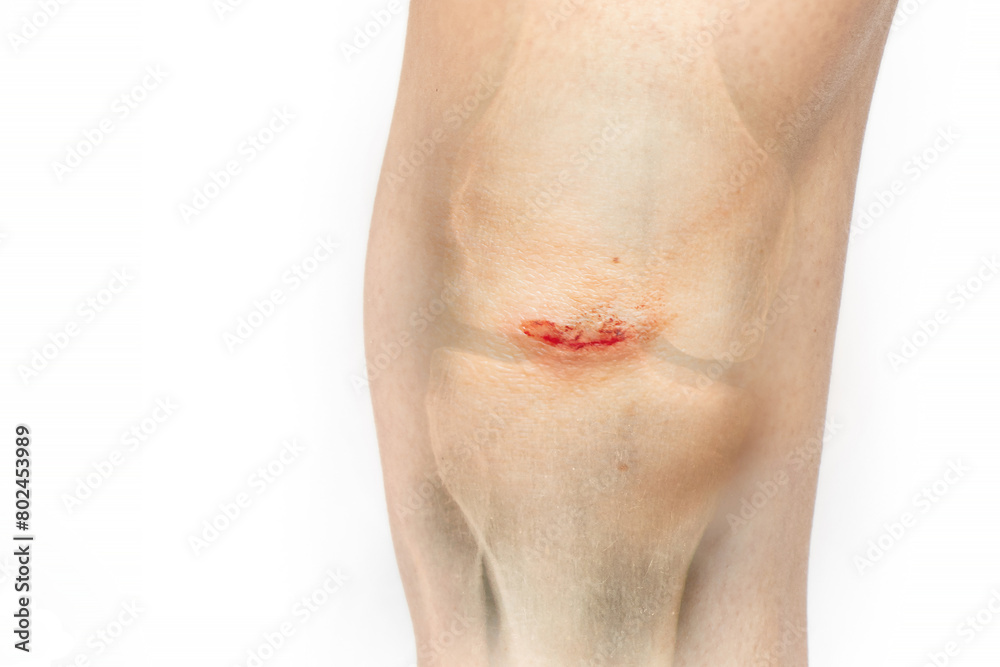 Wounds with blood on a girl's knee after a fall and an x-ray of her leg ...