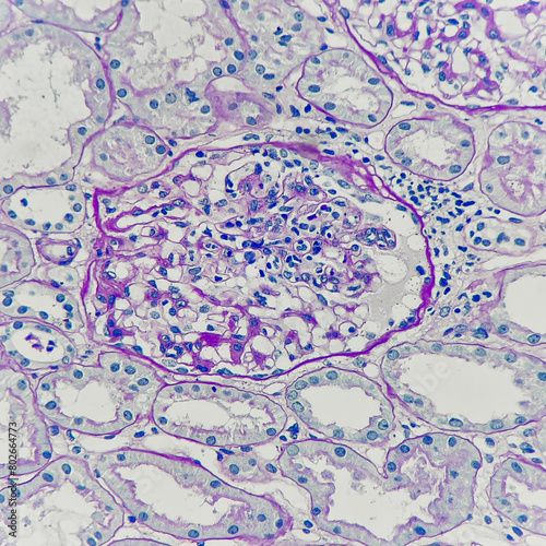 Camera photo of lupus nephritis showing endocapillary hypercellularity with leukocyte infiltrate, magnification 400x, photograph through a microscope