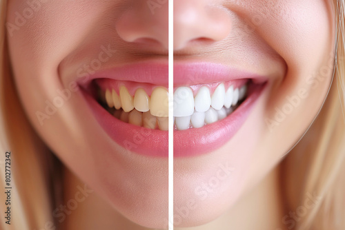 female open mouth with a smile with healthy white teeth before and after dental whitening close-up