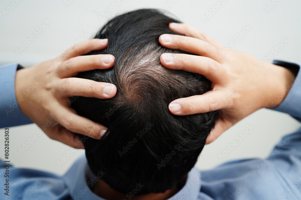 Naklejka premium Bald head in man, hair loss treatment health problem.