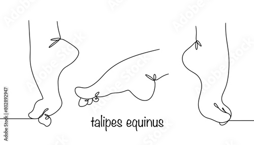 Talipes equinus photo