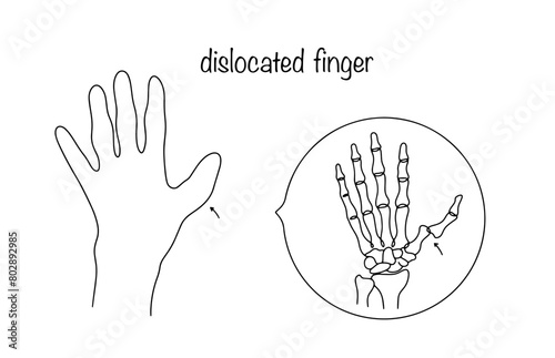 Dislocated thumb