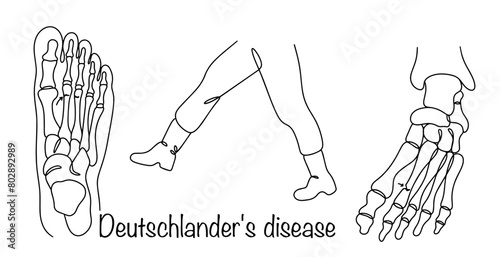 Deutschlander's disease