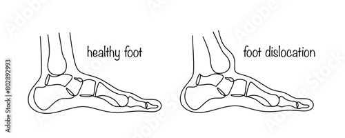 Foot dislocation