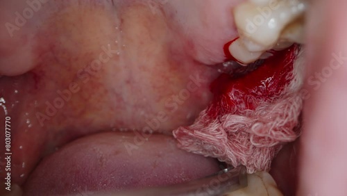 Tweezers Pull Tampon From Hole in Gum From Wisdom Tooth, Blood Drips After Dentist's Extraction.