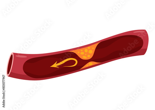 Atherosclerosis stage. Anatomy of heart attack. Arteriosclerotic vascular disease or ASVD. Atherosclerotic plaque in coronary artery. Vector illustration on white background