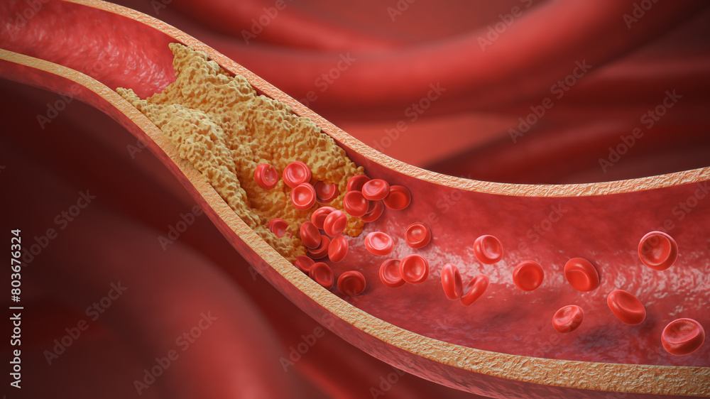 Obraz premium High Blood Cholesterol, Thickened Arteries and Veins, Red Blood Cells, 3d illustration.
