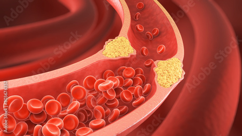 High Blood Cholesterol, Thickened Arteries and Veins, Red Blood Cells, 3d illustration. © Anusorn