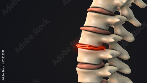 Tableau sur toile Degenerative disc in the human spine