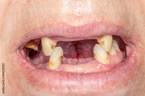 Dental front view of an adult woman occlusion teeth arches open lips. Teeth loss on anterior and posterior sector with remaining canines, a decayed upper molar and lower left side premolars.