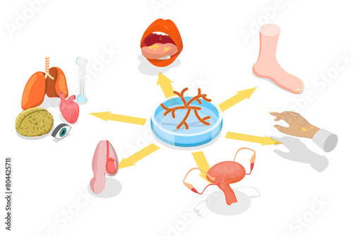 3D Isometric Flat  Illustration of Candidiasis, Medical Infographics