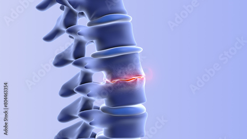 Bild auf Leinwand Human spine disc degeneration with osteophyte formation