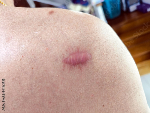 keloid scar on the her shoulder of a man photo