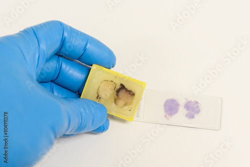 Scientist wear blue glove holding paraffin human tissue block and out of focus slide on white background.Doctor is examining histological sample, a biopsy in the laboratory of cancer research. photo