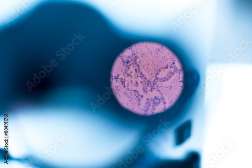 Selective focus human cells tissue in eyepiece of microscope in laboratory.Examining histological sample, a biopsy in the laboratory of cancer research.Medical patholology and cytology laboratory 