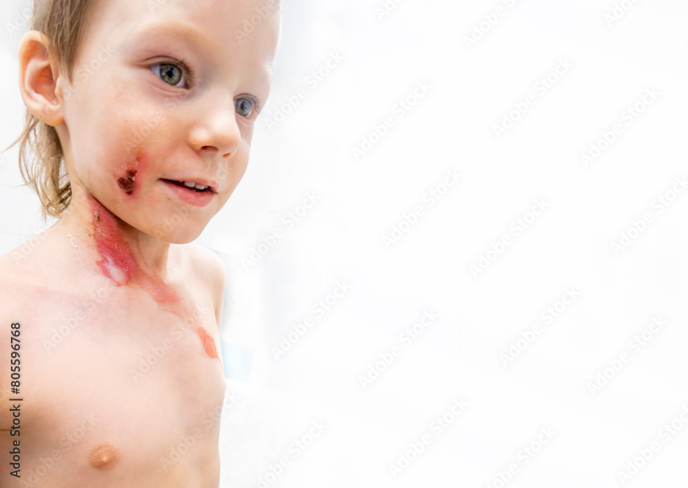 medical procedure dressing a boy with a first-degree burn from boiling water on his face, neck and chest