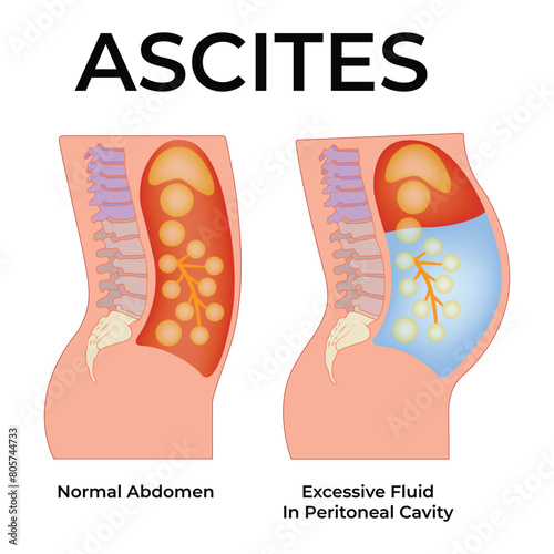 Ascites Science Design Vector Illustration Diagram