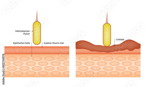 Helicobacter Pylori Epithelial Cells Vector Design Illustration Diagram