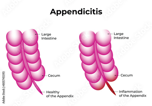 Appendicitis Science Design Vector Illustration Diagram
