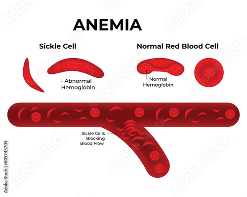 Anemia Science Design Vector Illustration Diagram