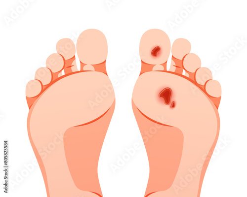 Diabetic foot ulcers vector isolated on white background.