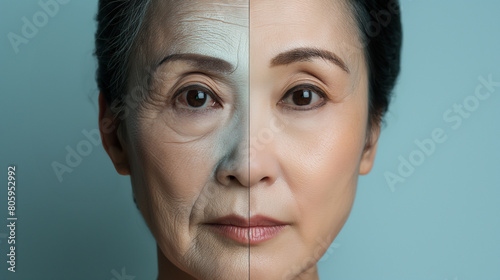 Korean woman before and after cosmetic procedures to eliminate wrinkles and tighten skin