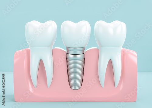 Dental implants on light blue background