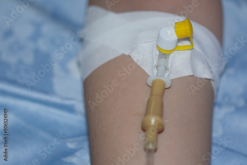 procedure for receiving an IV in a hospital