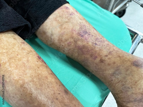 Top view of irritated legs skin with bruise of an old person Human health care and medical treatments concept