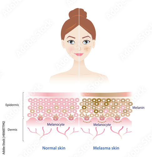 Infographic of normal and melasma skin on woman face vector illustration. Comparison of healthy epidermis skin layer, hyperpigmentation, melasma and dark spots. Skin care and beauty concept.