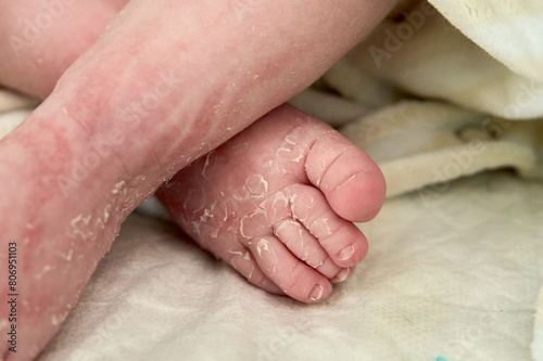 Infant baby feet having flaky skin. Newborn boy at hospital with very dry skin after born. Soft selective focus