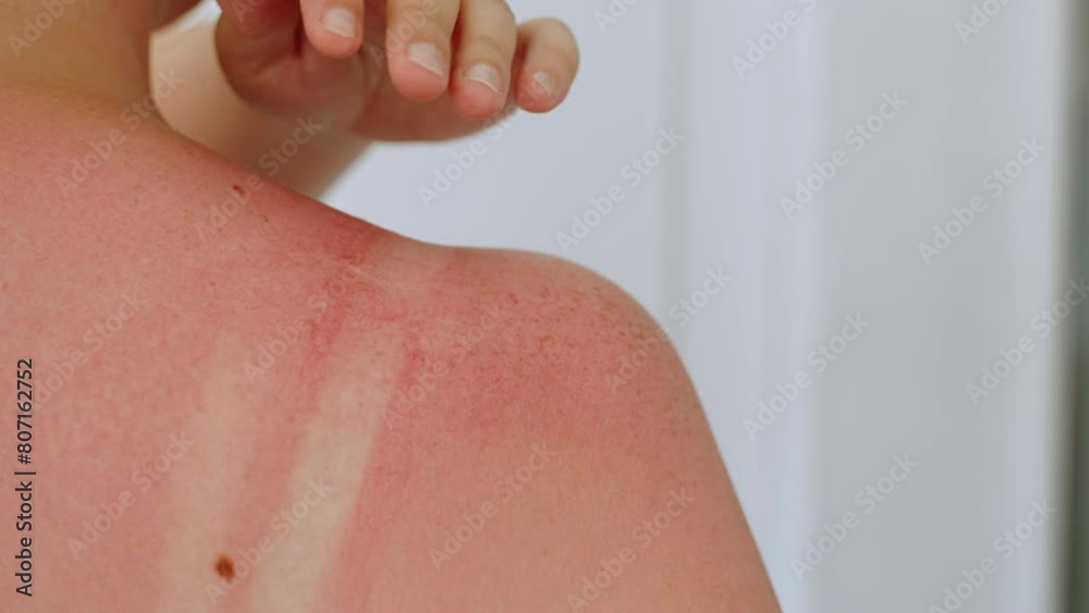 Close-up of shoulder with red and irritated skin after sunburn. Unrecognizable woman removes her bra strap and touches inflamed skin with her hand. Burns tender pale skin without protection.