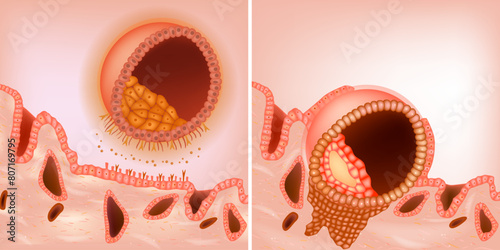The process during the embryo implantation. The blastocyst implants to the maternal endometrium. Blastocyst Apposition and Adhesion