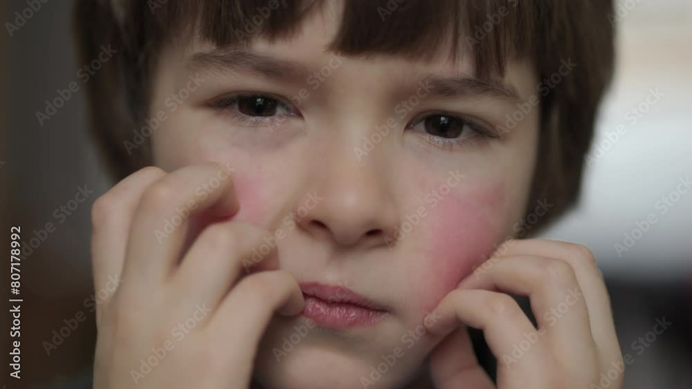 Child Scratching Red Rash on Face. Boy Scratches Atopic Skin. Dermatitis, Diathesis, Hives Allergy on Child Body and Face. Irritation and Pruritus. Boy Having Allergic Reaction on Skin to Food. Child Scratching Red Rash on Face. Boy Scratches Atopic Skin. Dermatitis, Diathesis, Hives Allergy on Child Body and Face. Irritation and Pruritus. Boy Having Allergic Reaction on Skin to Food.
