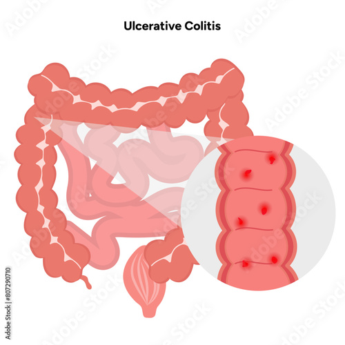 Ulcerative colitis 