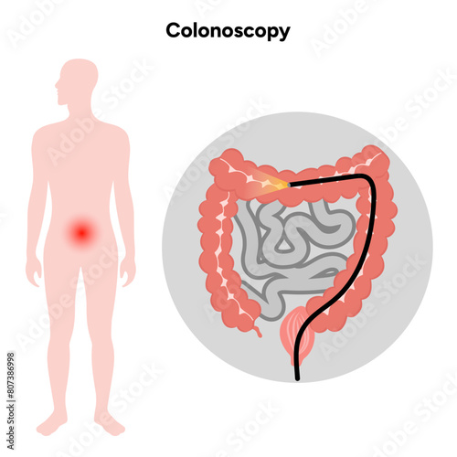 Colonoscopy diagram gastroscopy with endoscope 