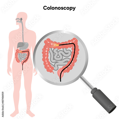 Colonoscopy diagram gastroscopy with endoscope 