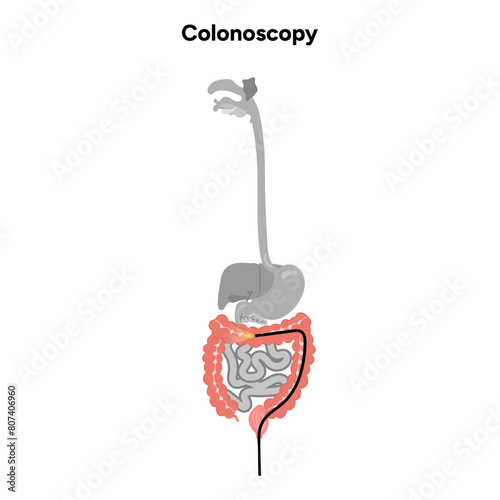 Colonoscopy diagram gastroscopy with endoscope 