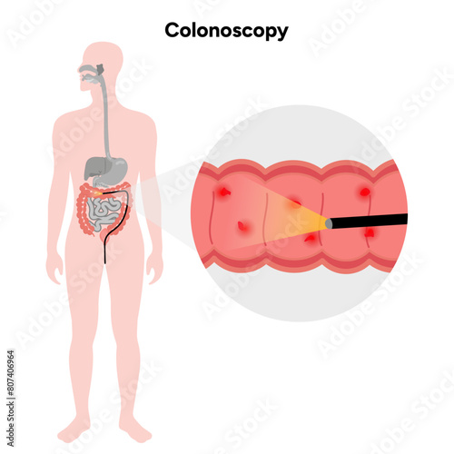 Colonoscopy diagram gastroscopy with endoscope 