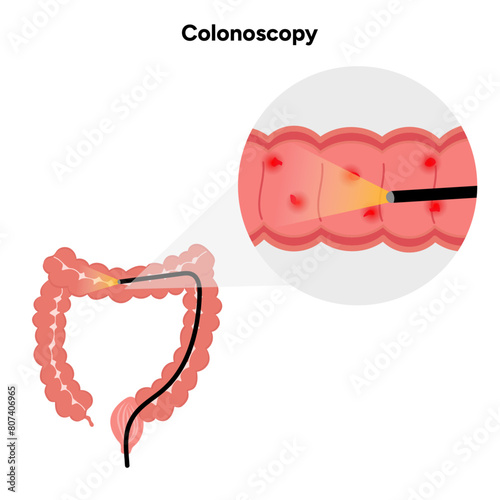 Colonoscopy zoom